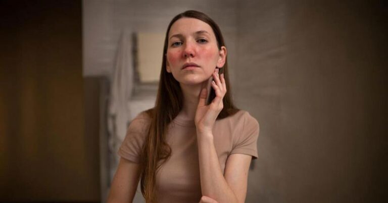 skin picking disorder